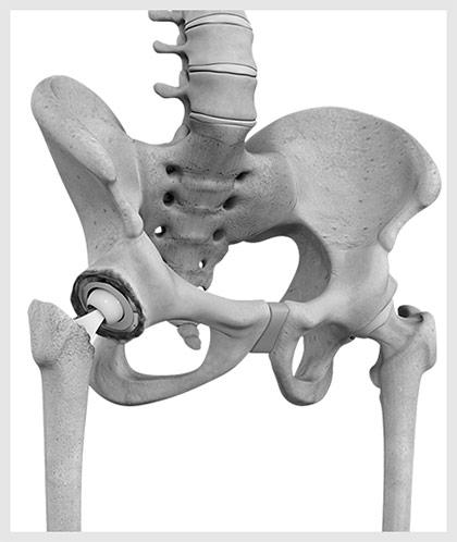 Total Hip Replacement Shared Decision Making Video